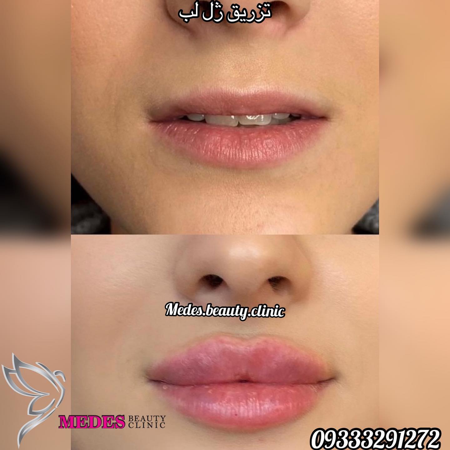 گالری تزریق ژل لب